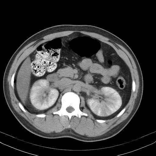 Striated nephrogram - acute pyelonephritis | Image | Radiopaedia.org