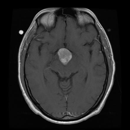 Craniopharyngioma | Radiology Reference Article | Radiopaedia.org