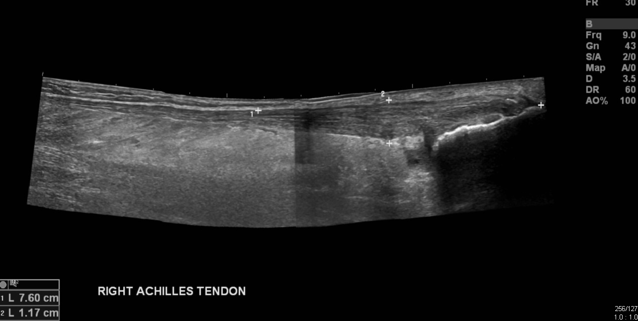 Haglund Syndrome And Deformity | Image | Radiopaedia.org