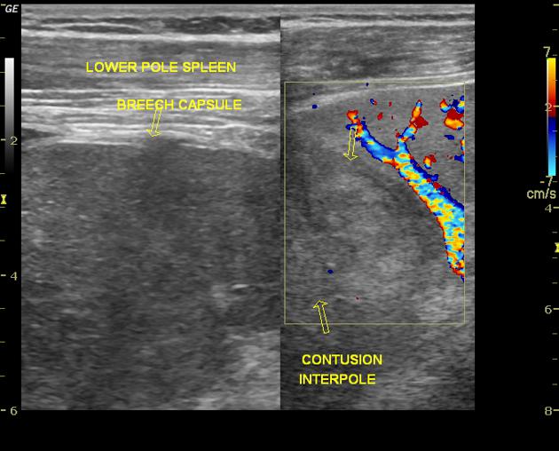 Splenic Trauma Radiology Reference Article