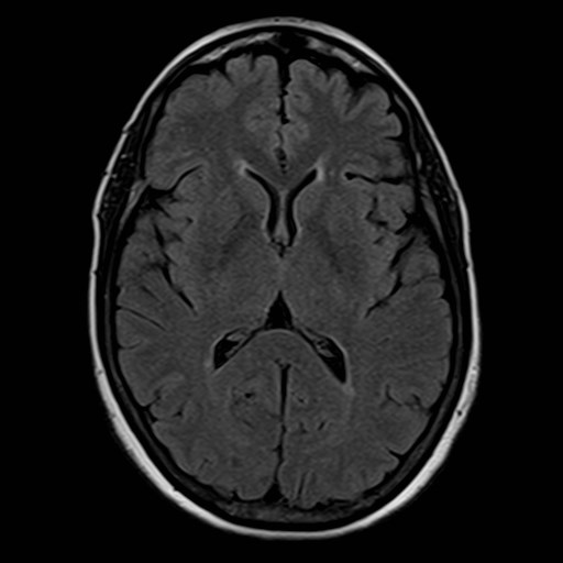 Multinodular and vacuolating neuronal tumor | Image | Radiopaedia.org