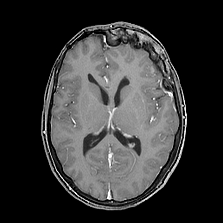 Proteus Syndrome With Sphenoid Wing Hyperostosis And Proptosis 