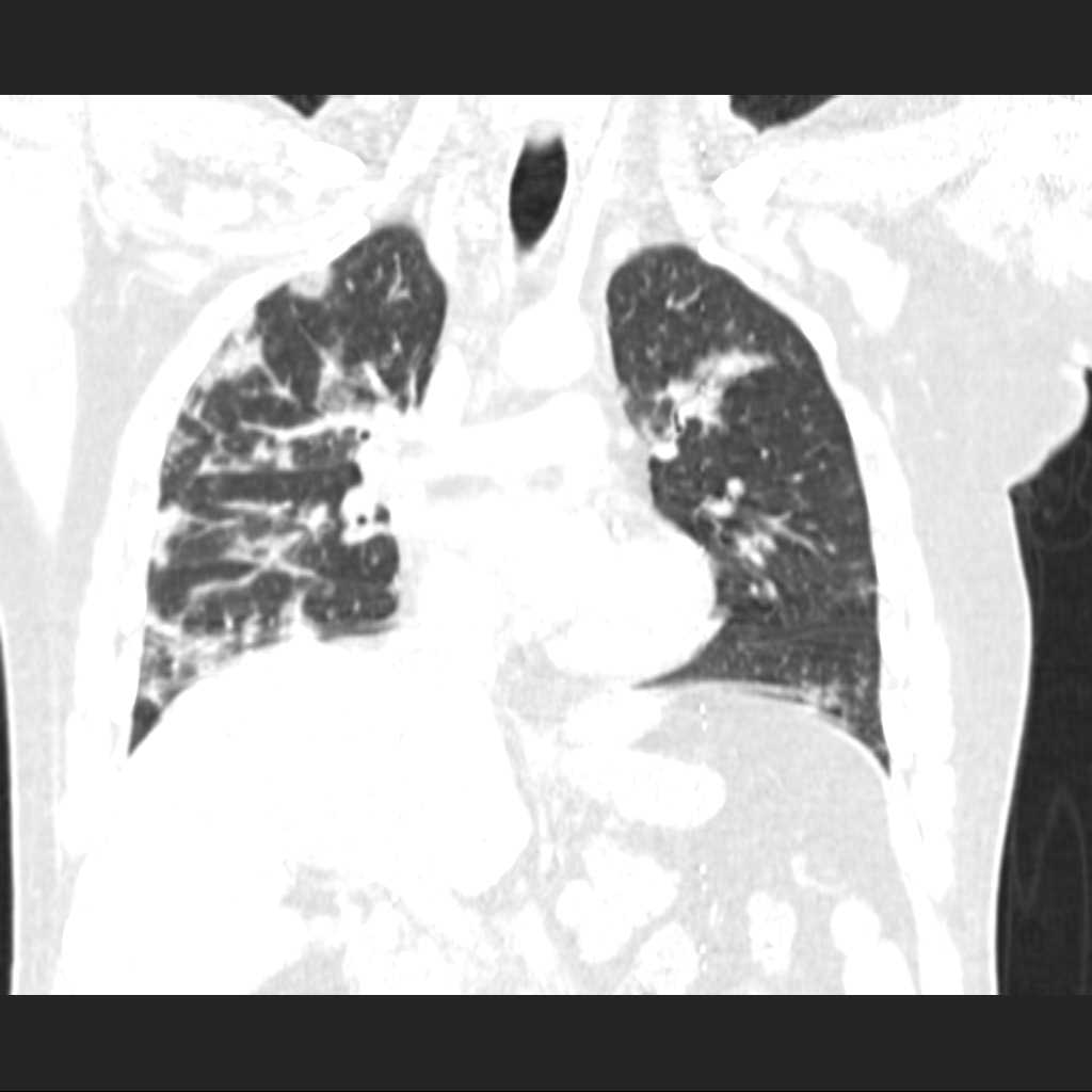 Cryptogenic Organizing Pneumonia Image Radiopaedia Org