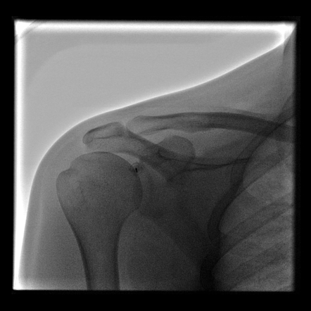 Bankart lesion with grade V SLAP tear (shoulder MR-arthrogram) | Image ...