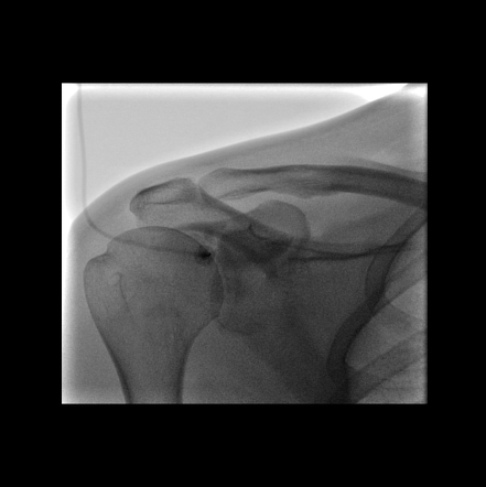 Bankart lesion with grade V SLAP tear (shoulder MR-arthrogram) | Image ...