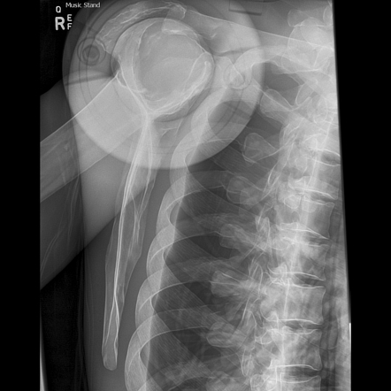 X Ray Shoulder Lateral View