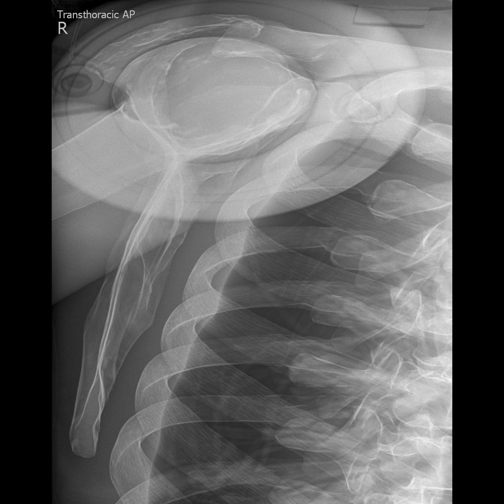 X Ray Shoulder Lateral View