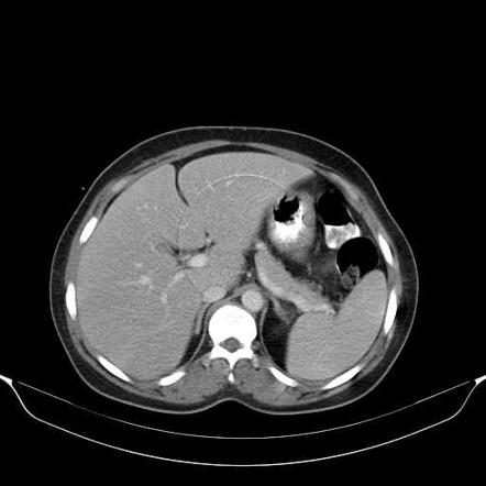 artifact radiopaedia