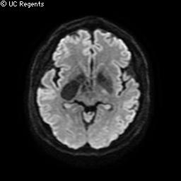 Giant perivascular cystic space | Image | Radiopaedia.org