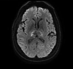 Bithalamic infarction secondary to venous thrombosis - lupus ...