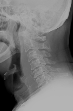 Migrating fishbone embedded in the prevertebral soft tissue | Radiology ...