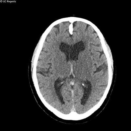 cortical vein thrombosis