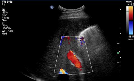 Ultrasound Of Emphysematous Cholecystitis Radiology Imaging