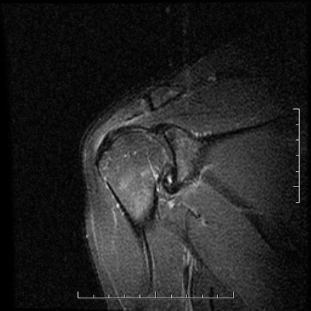 labral superior radiopaedia posterior slap radiology iii coronal