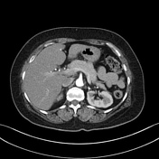 CT pancreas (protocol) | Radiology Reference Article | Radiopaedia.org