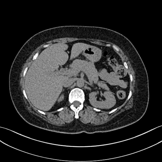 Normal CT multi-phase pancreas | Image | Radiopaedia.org