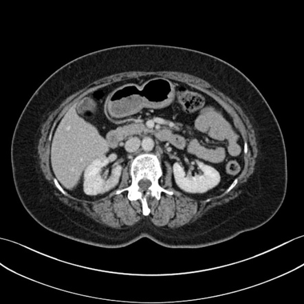 Normal CT multi-phase pancreas | Image | Radiopaedia.org