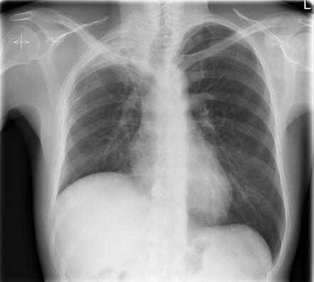 Radiation-induced lung disease | Radiology Reference Article ...