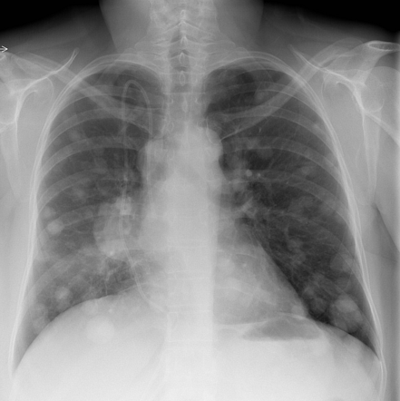 lung cancer stage 2 xray