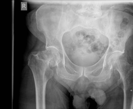 Subcapital neck of femur fracture | Image | Radiopaedia.org