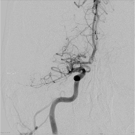 MCA infarction | Image | Radiopaedia.org