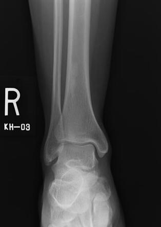 Healed non-ossifying fibroma | Image | Radiopaedia.org