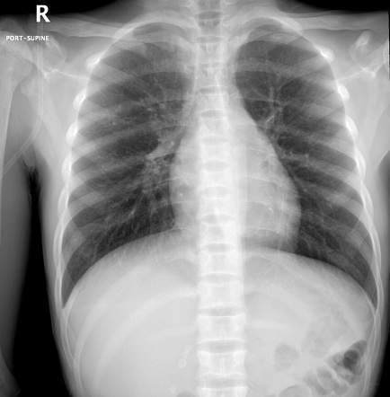 H-shaped vertebrae in patient with sickle cell anemia | Radiology Case ...