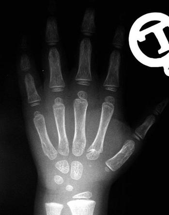 Pseudoepiphysis of 2nd metacarpal base | Image | Radiopaedia.org