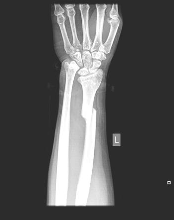 Galeazzi fracture | Radiology Case | Radiopaedia.org