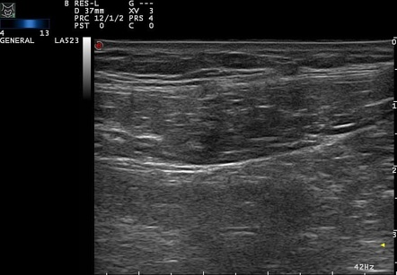 Muscle Hernia Ultrasound