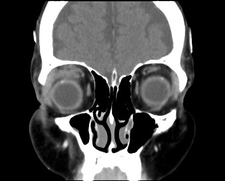 Orbital pseudotumor | Radiology Case | Radiopaedia.org