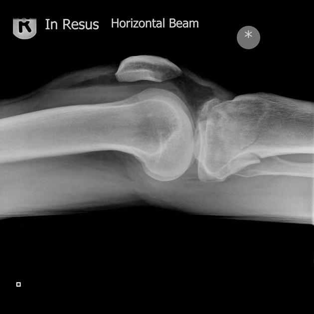 Knee radiograph (an approach) | Radiology Reference Article ...