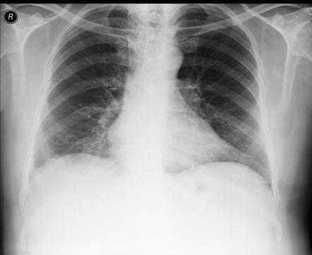 Azygos lobe | Radiology Reference Article | Radiopaedia.org