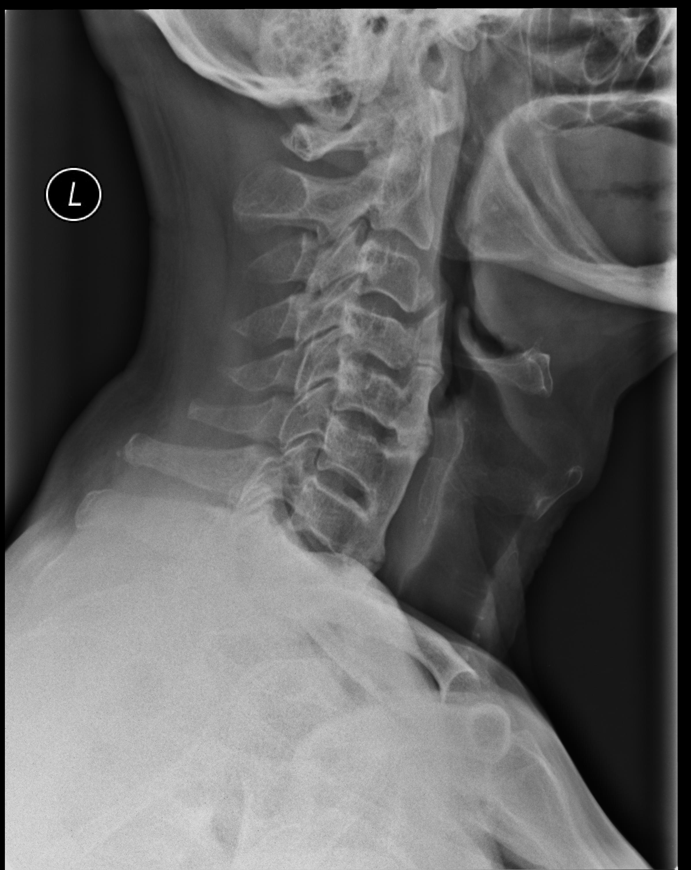 diffuse-idiopathic-skeletal-hyperostosis-dish-image-radiopaedia