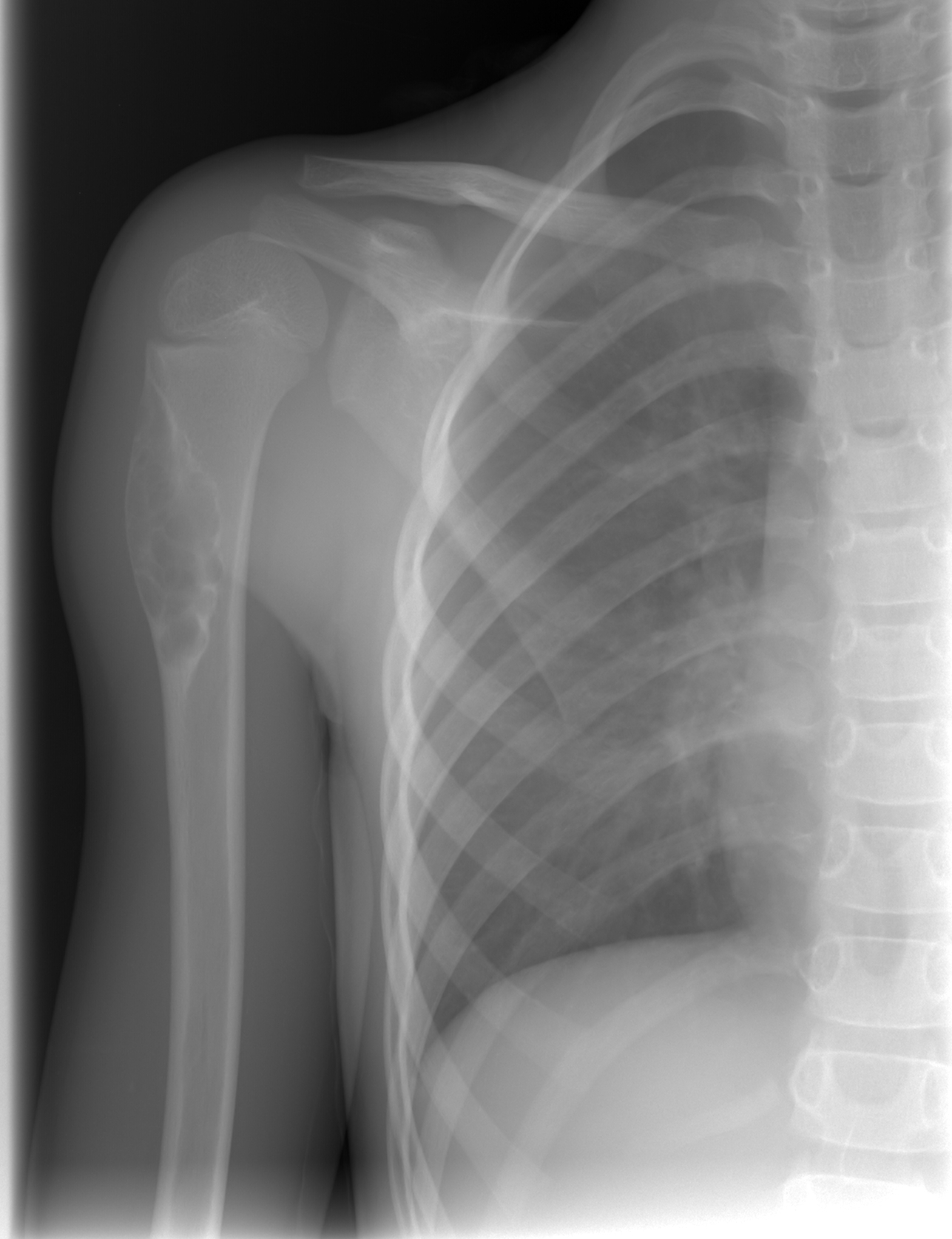 Non-ossifying fibroma (NOF) | Image | Radiopaedia.org