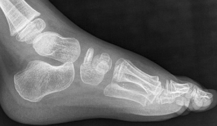 Navicular avascular necrosis (Köhler disease) | Image | Radiopaedia.org