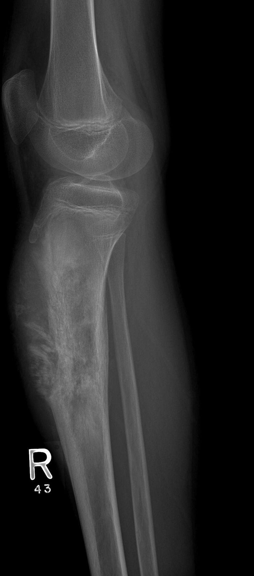 Osteosarcoma - proximal tibia | Image | Radiopaedia.org