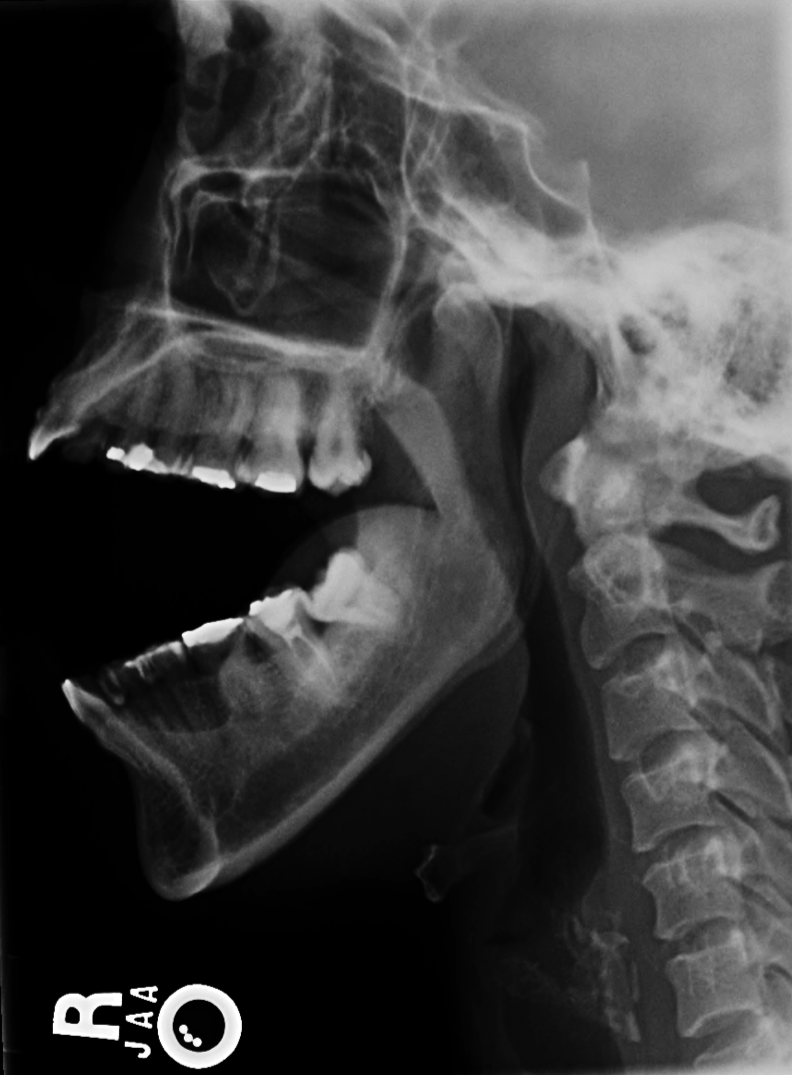 Temporomandibular joint dislocation | Image | Radiopaedia.org