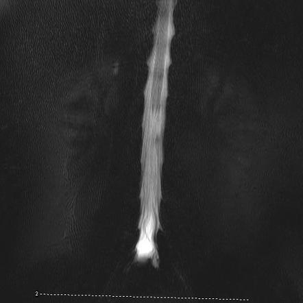 Conjoined nerve root | Image | Radiopaedia.org