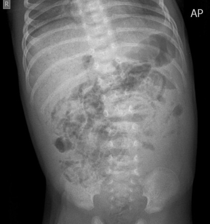 Viewing playlist: Pneumatosis Xray | Radiopaedia.org