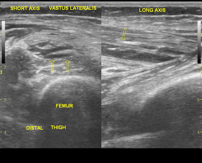 Vastus lateralis muscle abscess | Image | Radiopaedia.org