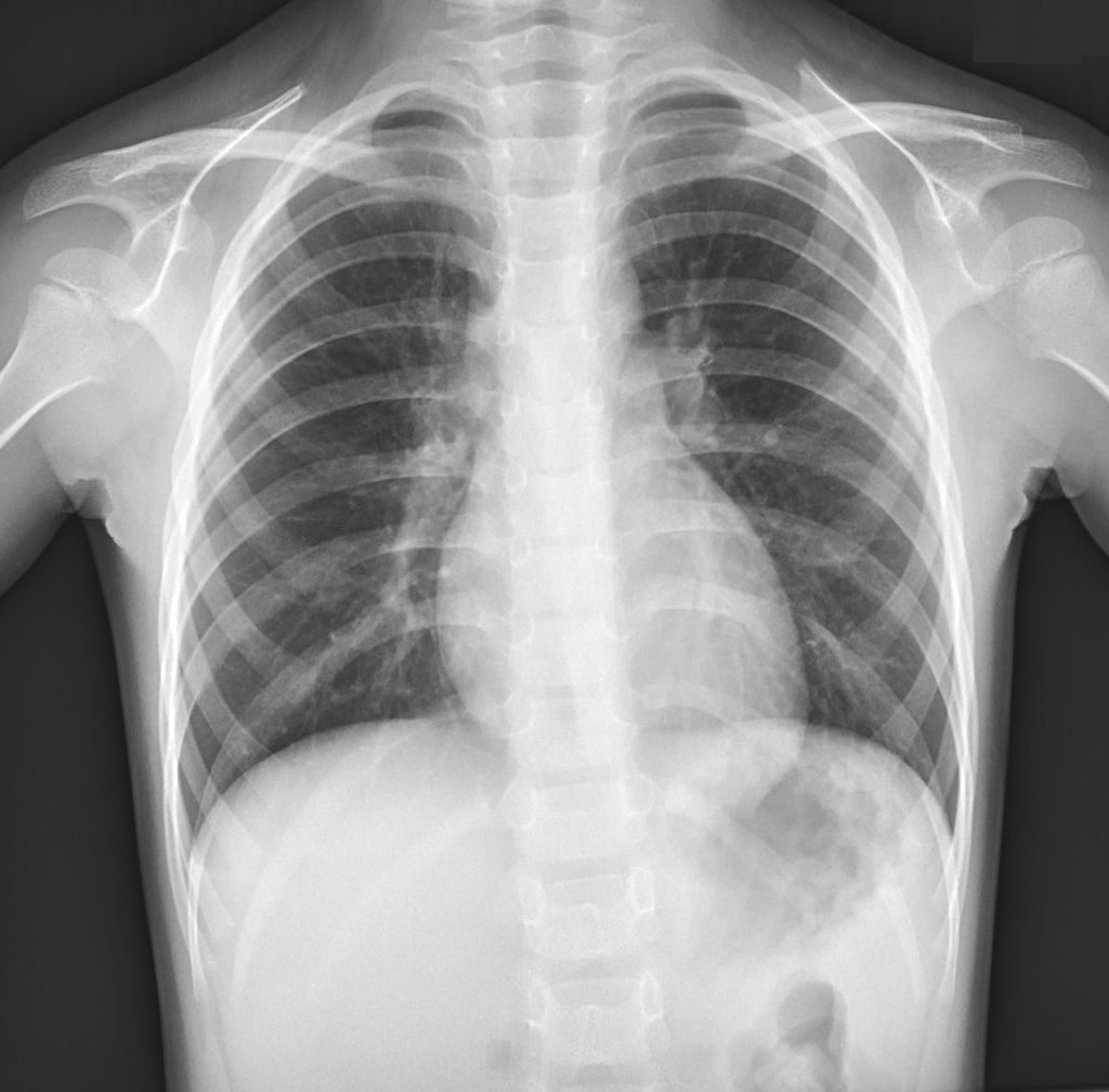 Normal Chest X Ray Images