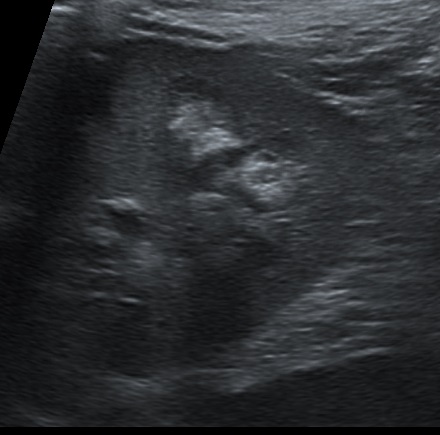 Medullary nephrocalcinosis | Image | Radiopaedia.org