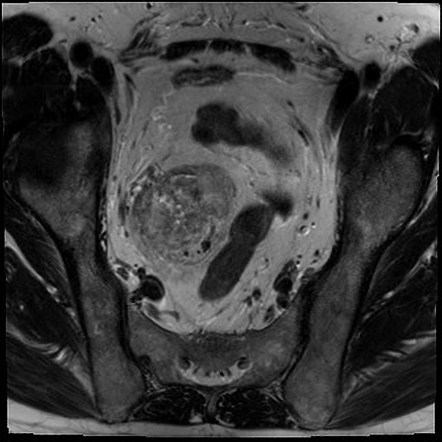 Hibernoma | Radiology Reference Article | Radiopaedia.org