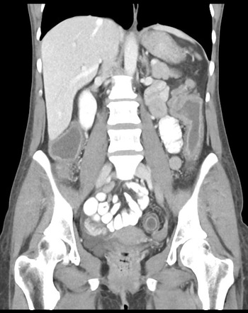 Crohn's Colitis With Malignant Splenic Flexure Mass 