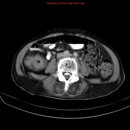 Arachnoiditis ossificans | Image | Radiopaedia.org