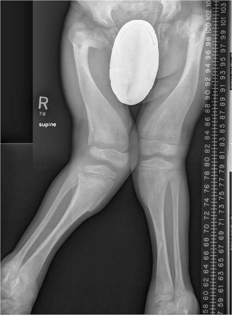 Stuve-Wiedemann syndrome | Radiology Case | Radiopaedia.org