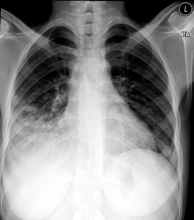 Multilobar pneumonia | Radiology Reference Article | Radiopaedia.org