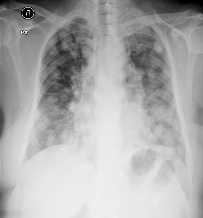 Cannonball metastases (lungs) | Radiology Reference Article ...