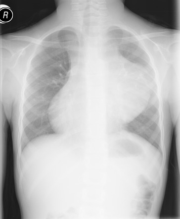 Anterior mediastinal mass in the exam | Radiology Reference Article ...